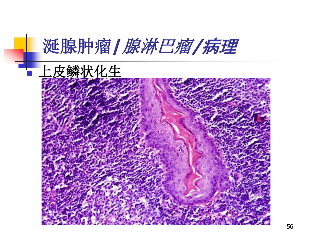 涎腺肿瘤/腺淋巴瘤/病理上皮鳞状化生 涎腺肿瘤/腺淋巴瘤/病理上皮