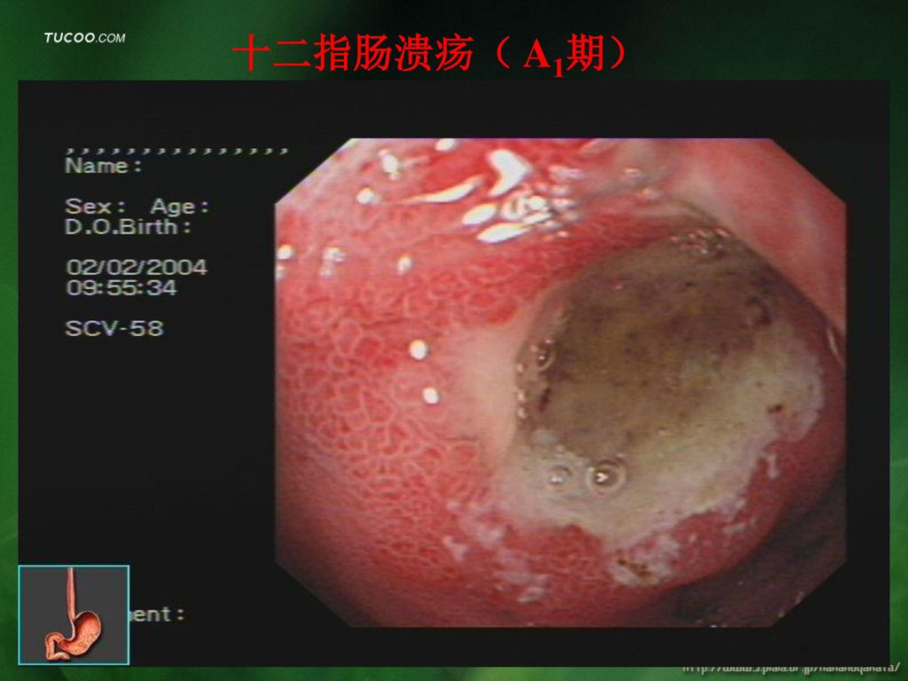 胃窦溃疡(a1期) 胃角溃疡(h1期) 胃角溃疡(h2期)