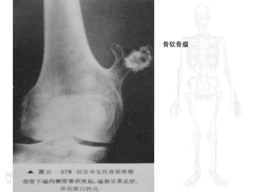 骨肿瘤 河南大学淮河医院骨科 张永利.