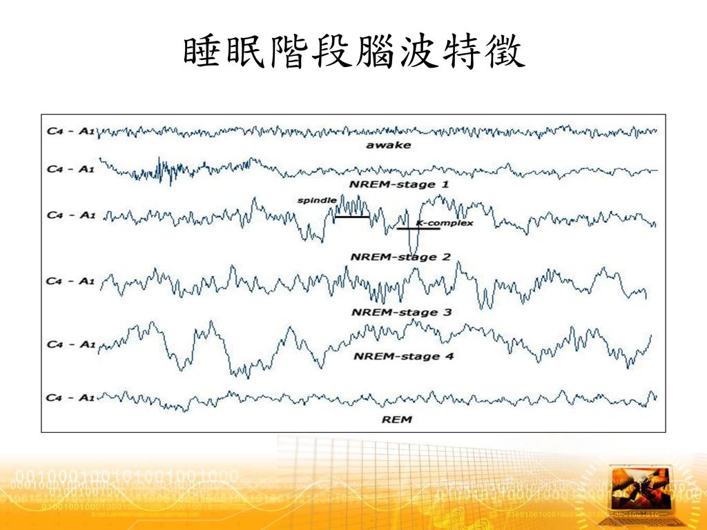 出现高振幅的δ波(2~4cps), δ波占20%~50%,期间偶有纺锤波会出现