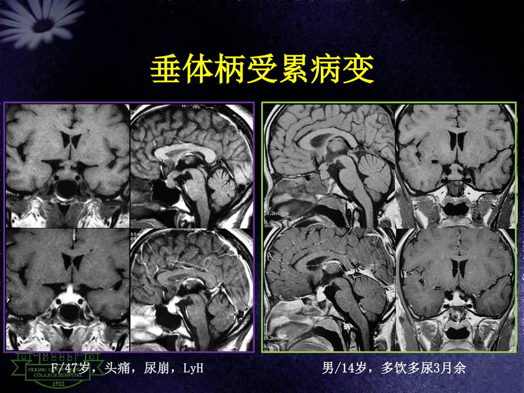 presentation on theme: "垂体病变mri诊断思路 及少见病变 北京协和