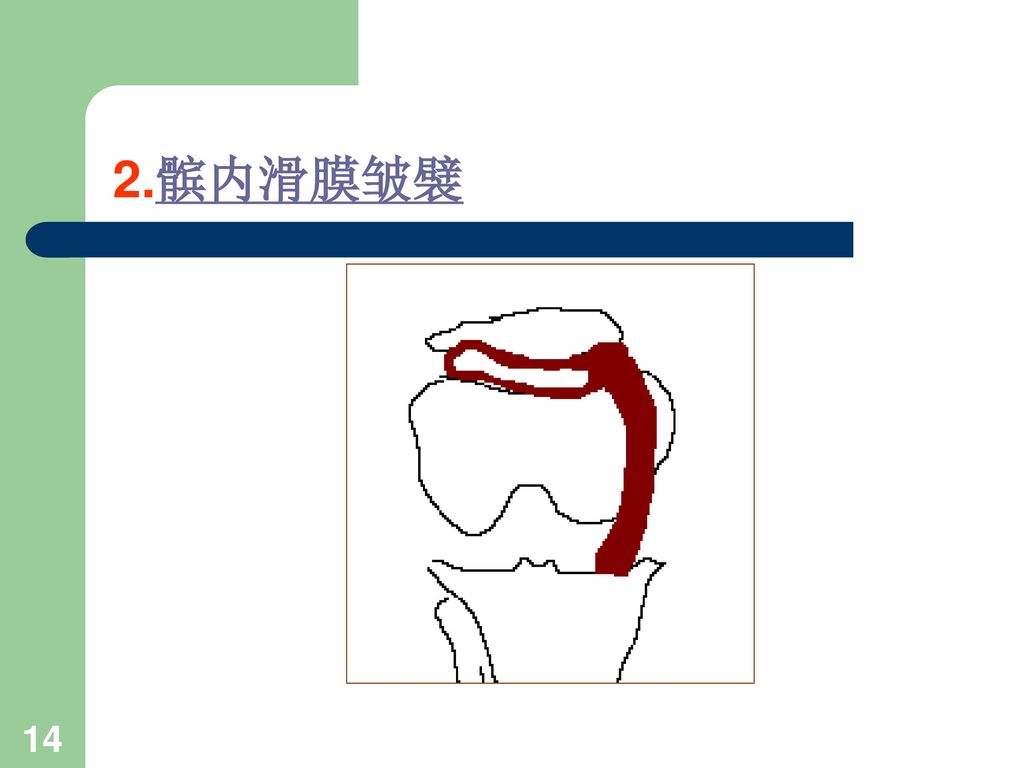 滑膜皱襞综合征.