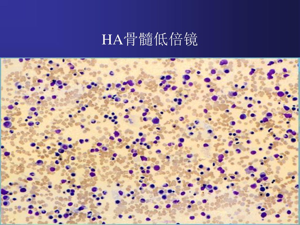 溶血性贫血 ( hemolytic anemia ha )