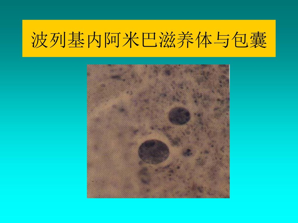 阿米巴肝脓肿ct检查示肝右叶单个脓肿 阿米巴肝脓肿组织切片