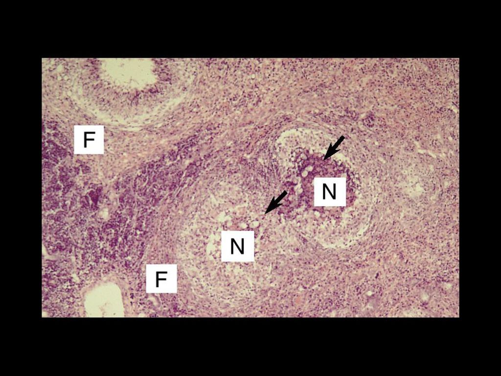 细菌性痢疾 bacillary dysentery