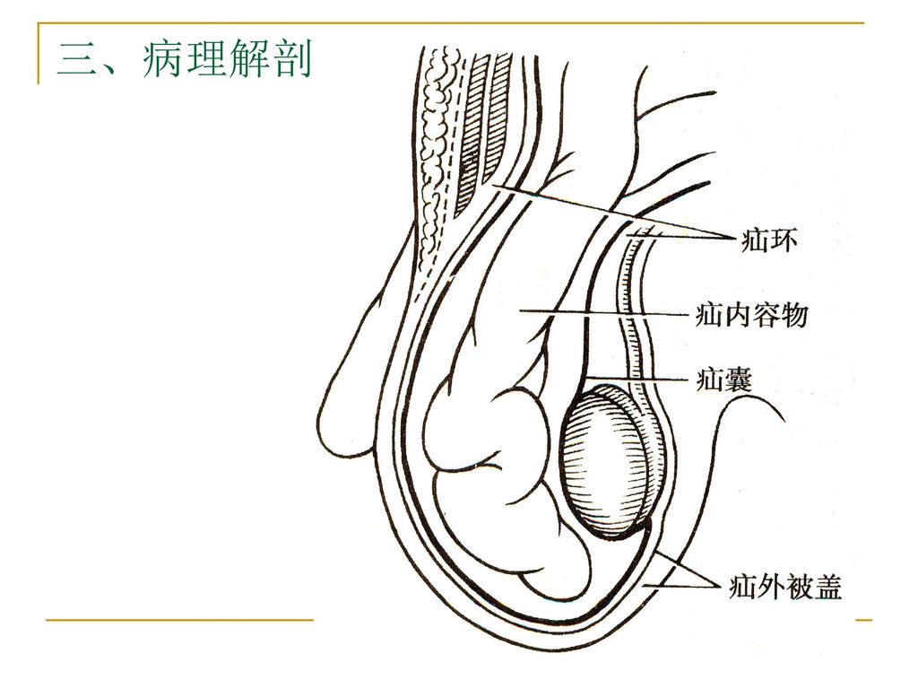 腹外疝病人的护理.