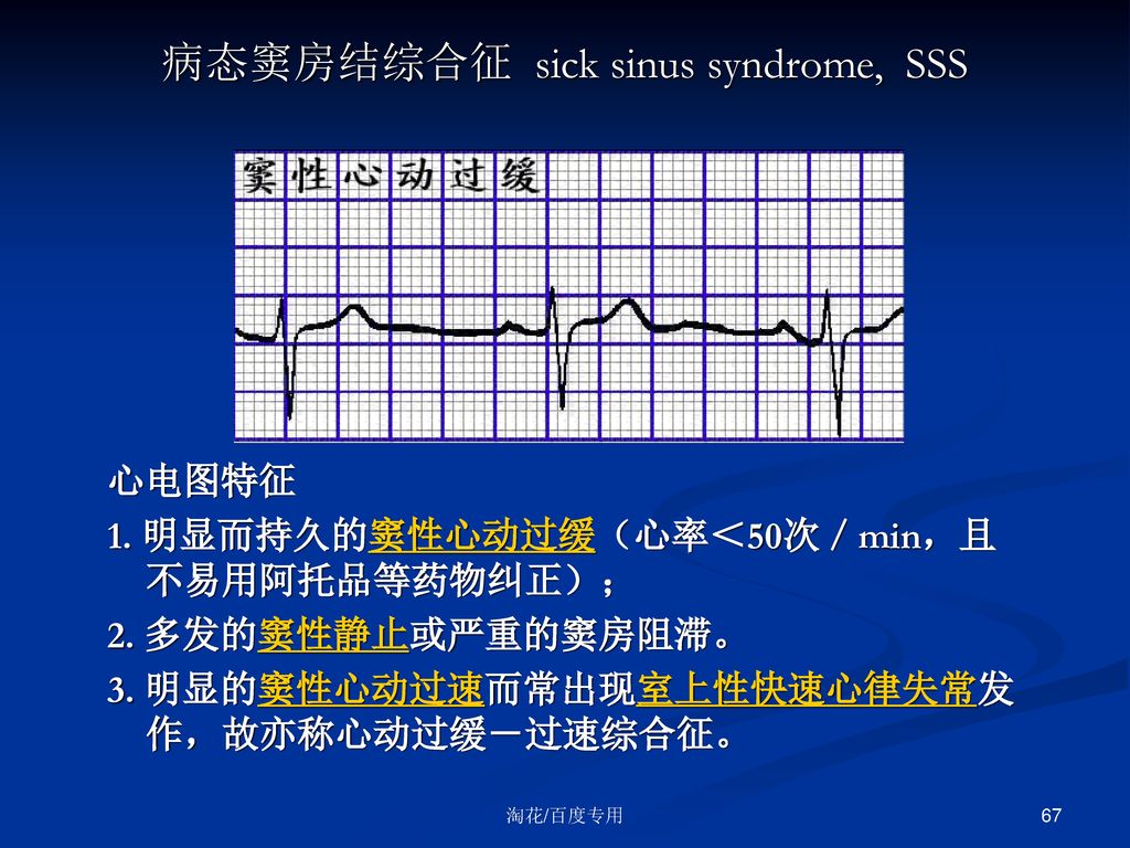 病态窦房结综合征 sick sinus syndrome, sss 心电图特征1.