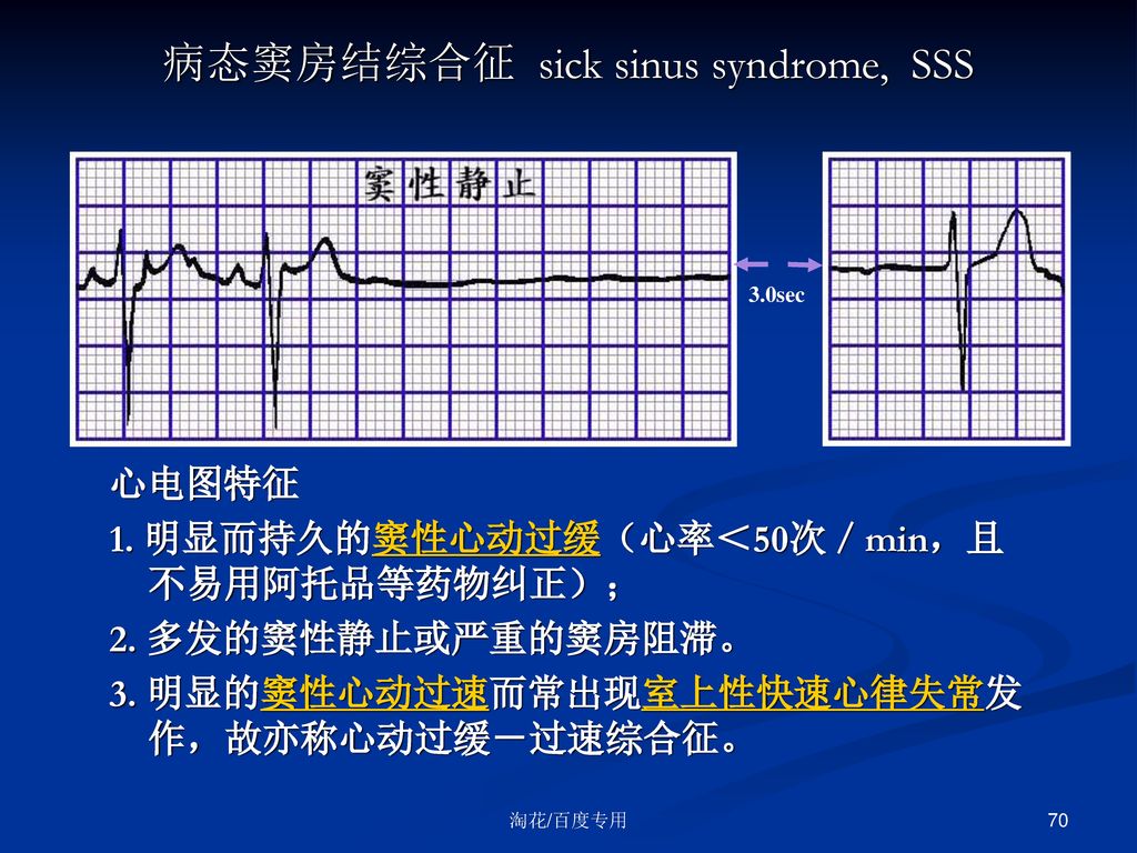 病态窦房结综合征 sick sinus syndrome, sss 3.0sec心电图特征1.