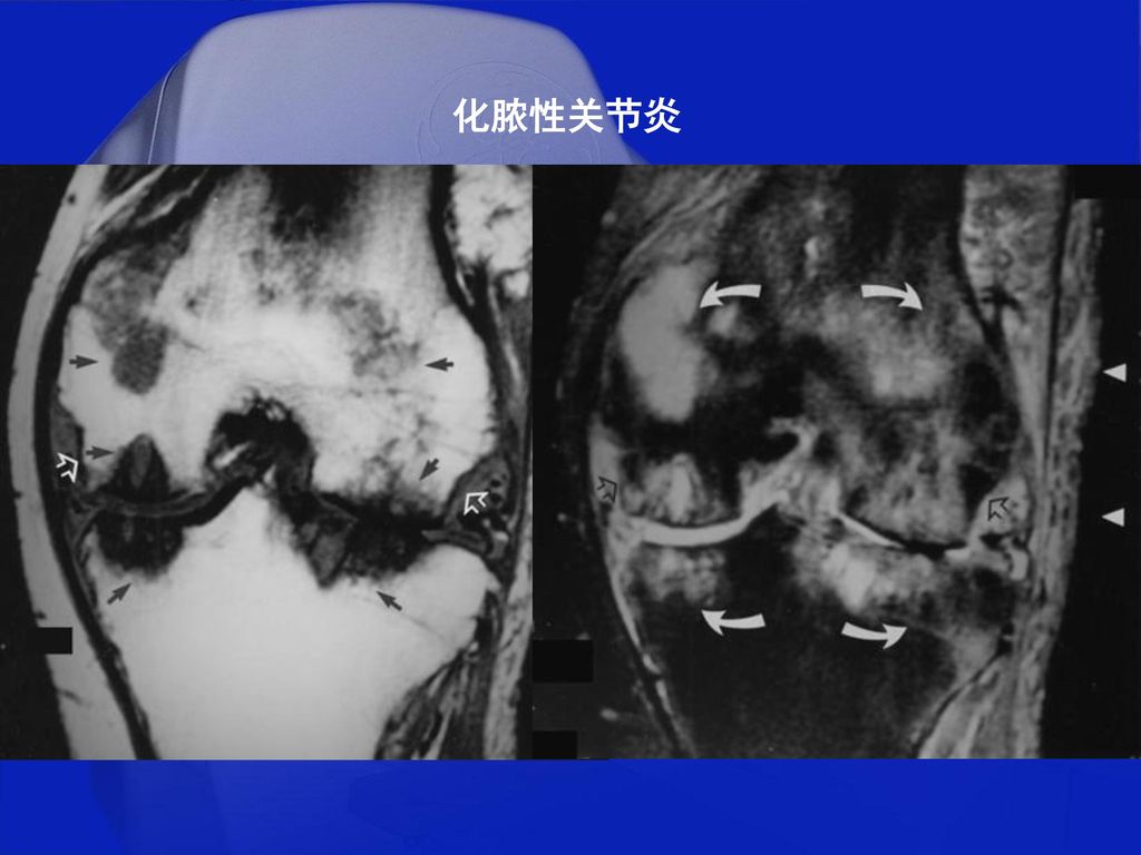 tra                               56                化脓性关节炎