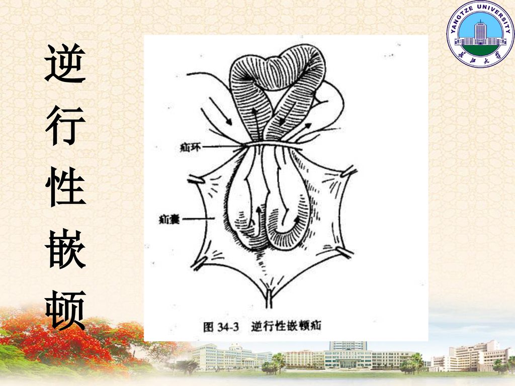 几种特殊疝◆滑疝◆richter疝◆littre疝◆逆行性嵌顿