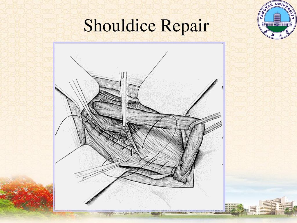 shouldice repair 无张力疝修补术 tension-free repair same