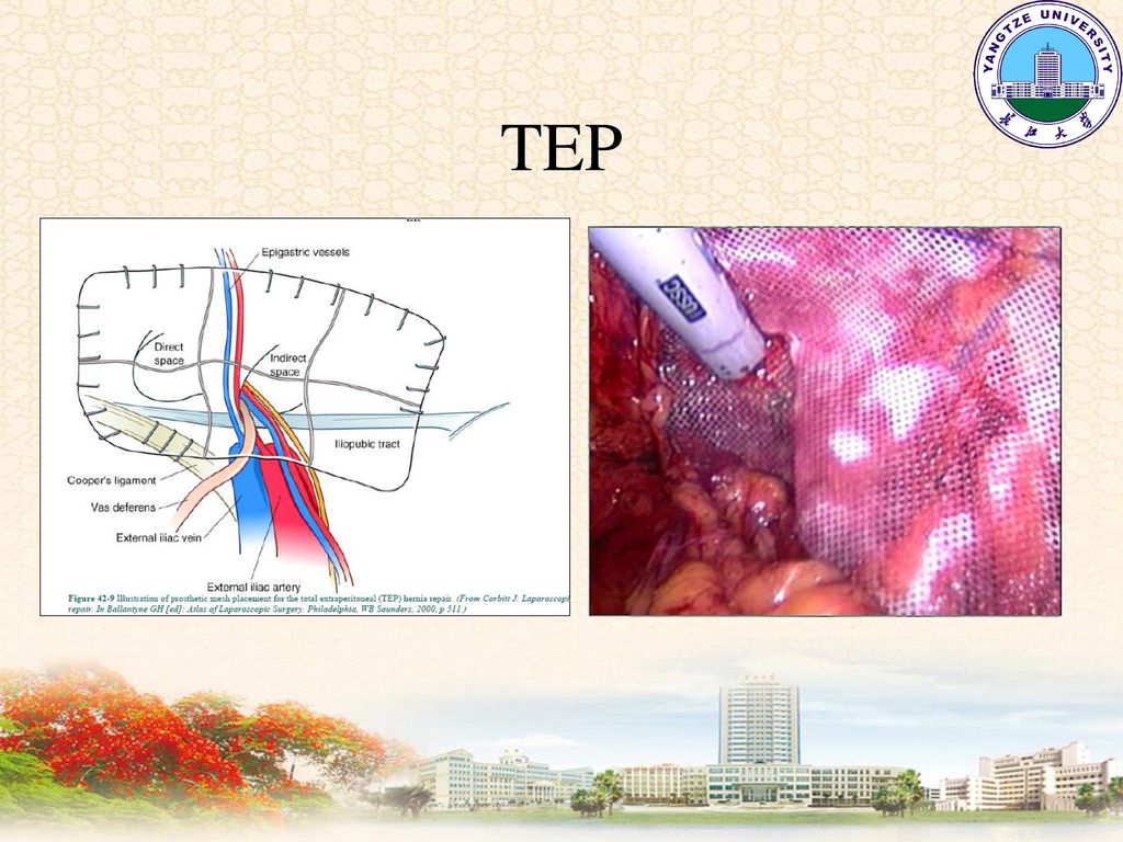 腹外疝 abdominal hernia 长江大学临床医学院 外科教研室.