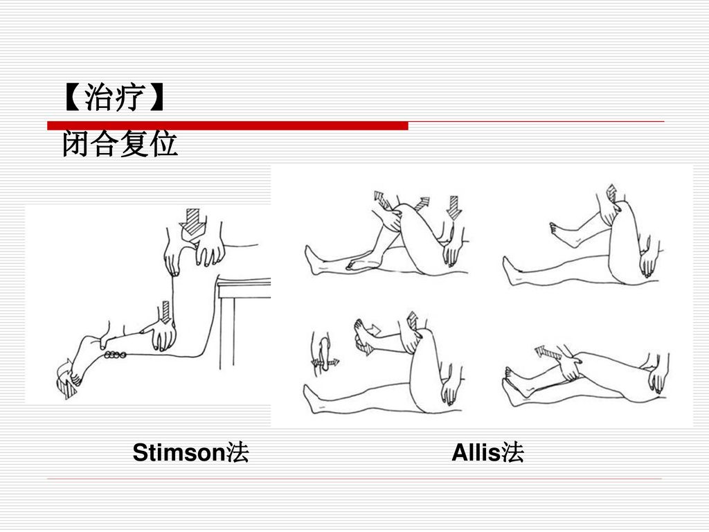 【治疗】闭合复位stimson法allis法         