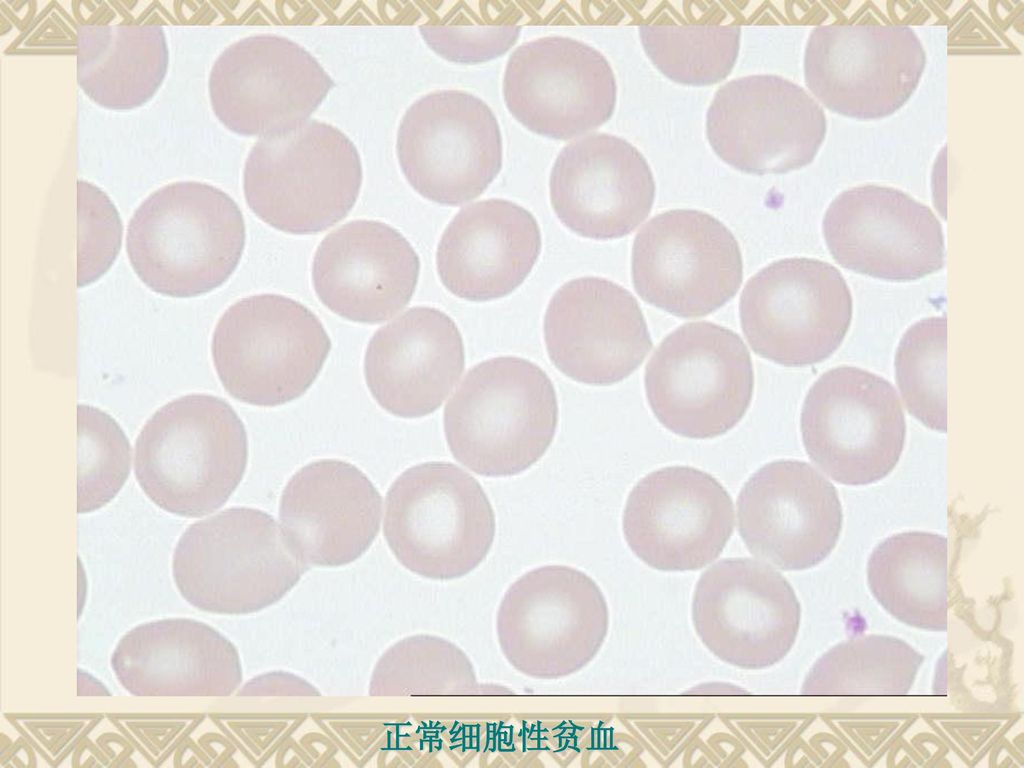 血液系统疾病 (hematological disease) 贫  血 电镜下红细胞形态