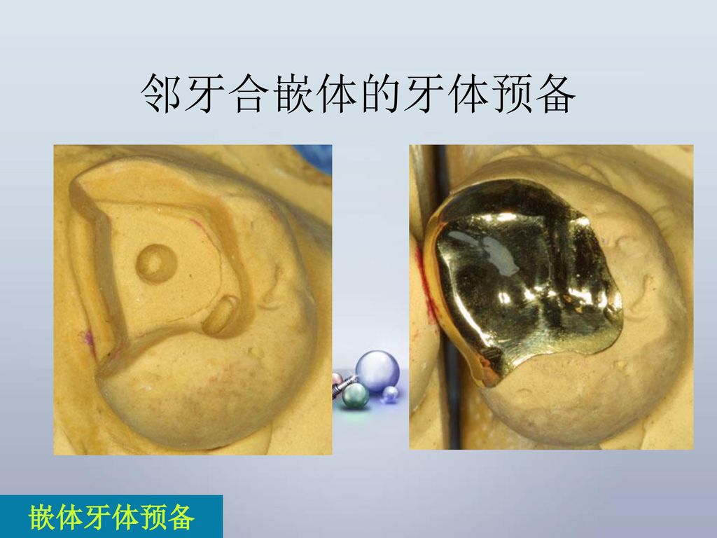 后牙邻牙合金属嵌体的牙体预备徐州医学院口腔医学院