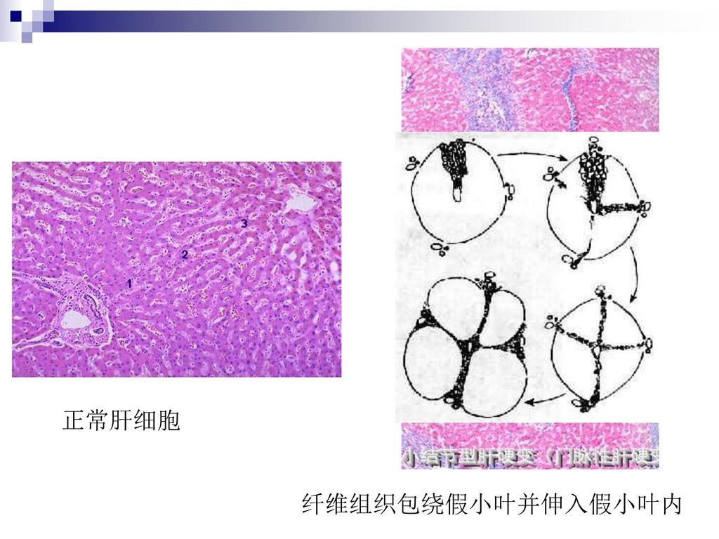 消化系统疾病 第四节 肝硬化.