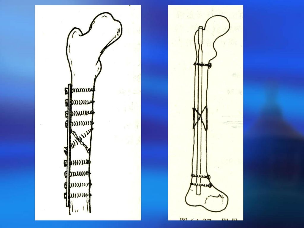 股骨干骨折 直接暴力 横形或粉碎性骨折 间接暴力 斜形或螺旋形骨折