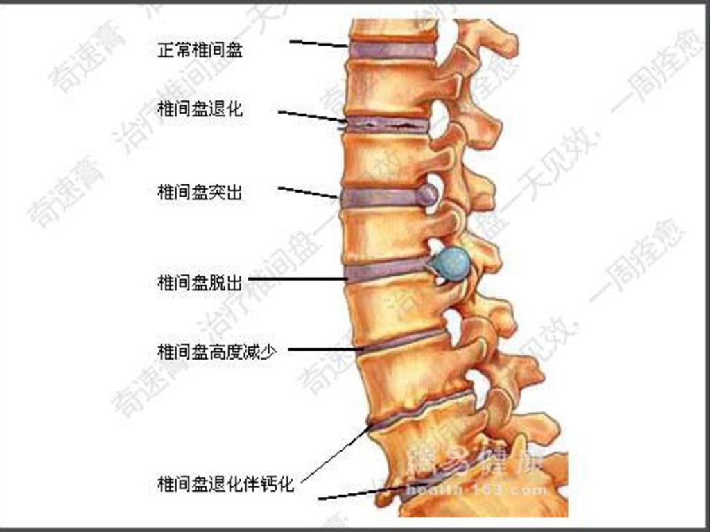 一,腰椎间盘突出症 椎体的结构                      5