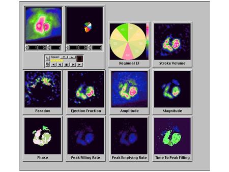 Multiple gated ventriculography, MUGA Imaging the blood-pool of the heart by synchronizing scintigraphic recording with electrocardigram Repetitively.