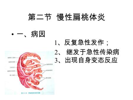 第二节 慢性扁桃体炎 一、病因 1 、反复急性发作； 2 、 继发于急性传染病 3 、出现自身变态反应.