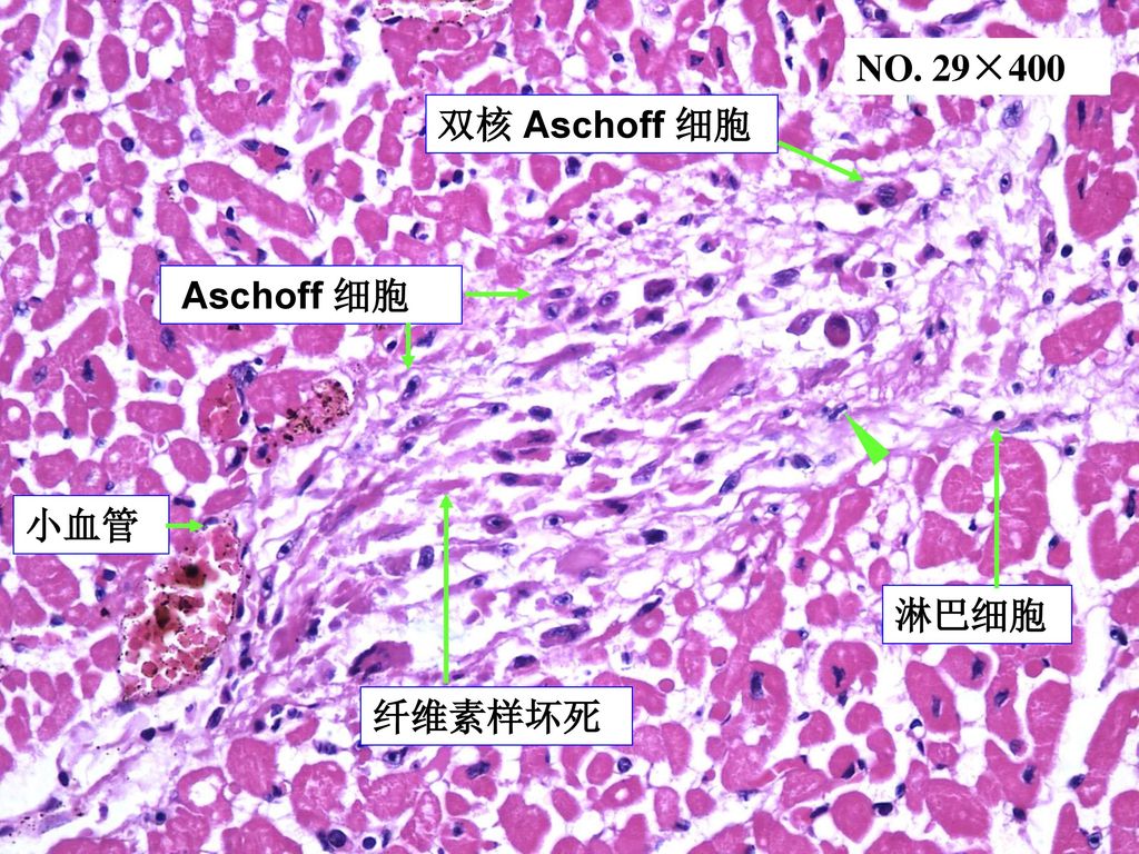 NO. 29×400 双核 Aschoff 细胞 Aschoff 细胞 小血管 淋巴细胞 纤维素样坏死