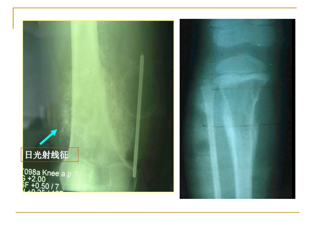 骨沉积(反应骨,类骨,肿瘤骨 骨破坏(骨吸收,溶骨性缺损 codman三角