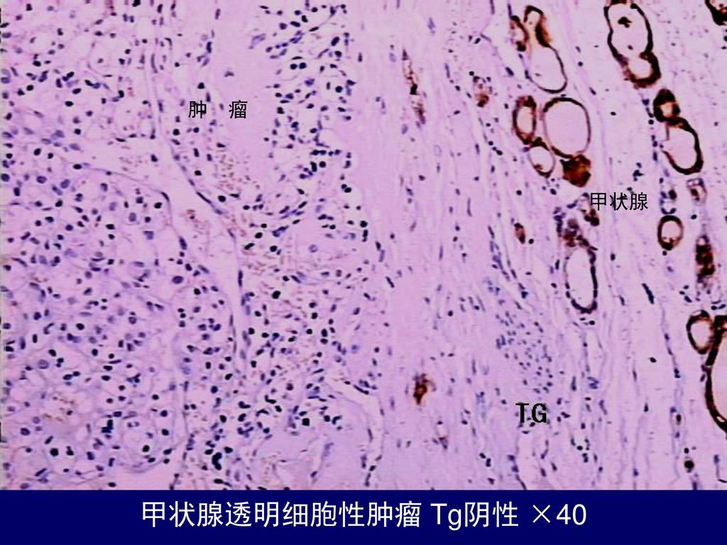 直接蔓延 转移性 低分化癌 恶性 甲状腺 结节 结节性 甲状腺肿 肿瘤