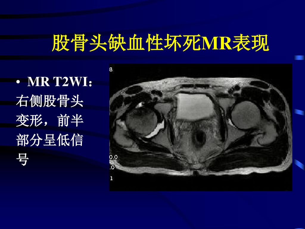 股骨头缺血性坏死MR表现 MR T2WI： 右侧股骨头 变形，前半 部分呈低信 号