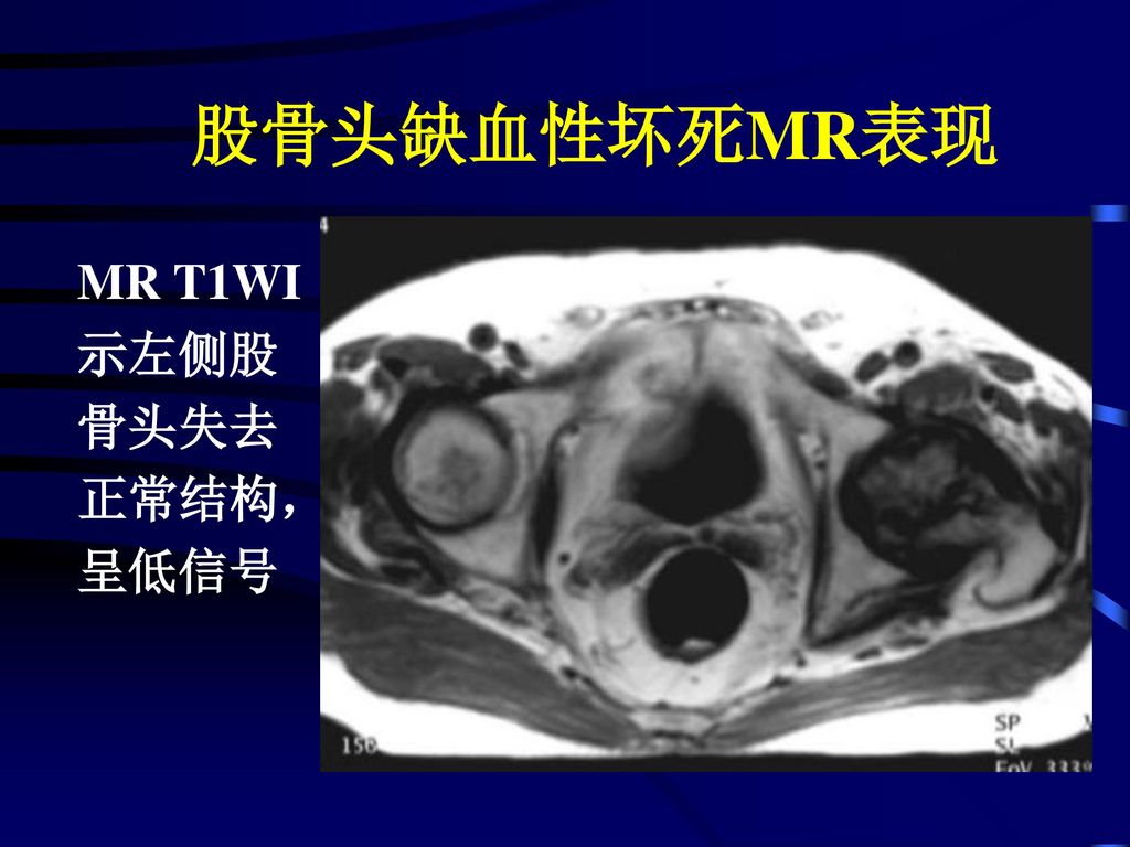 股骨头缺血性坏死MR表现 MR T1WI 示左侧股 骨头失去 正常结构， 呈低信号