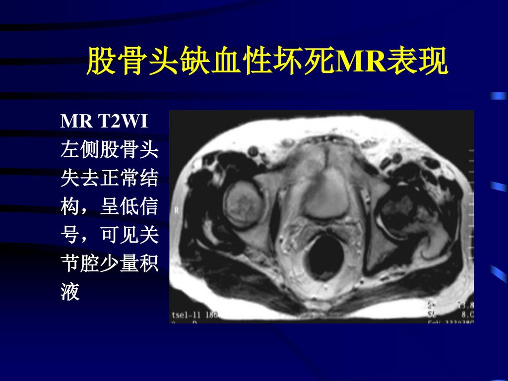 股骨头缺血性坏死MR表现 MR T2WI 左侧股骨头 失去正常结 构，呈低信 号，可见关 节腔少量积 液