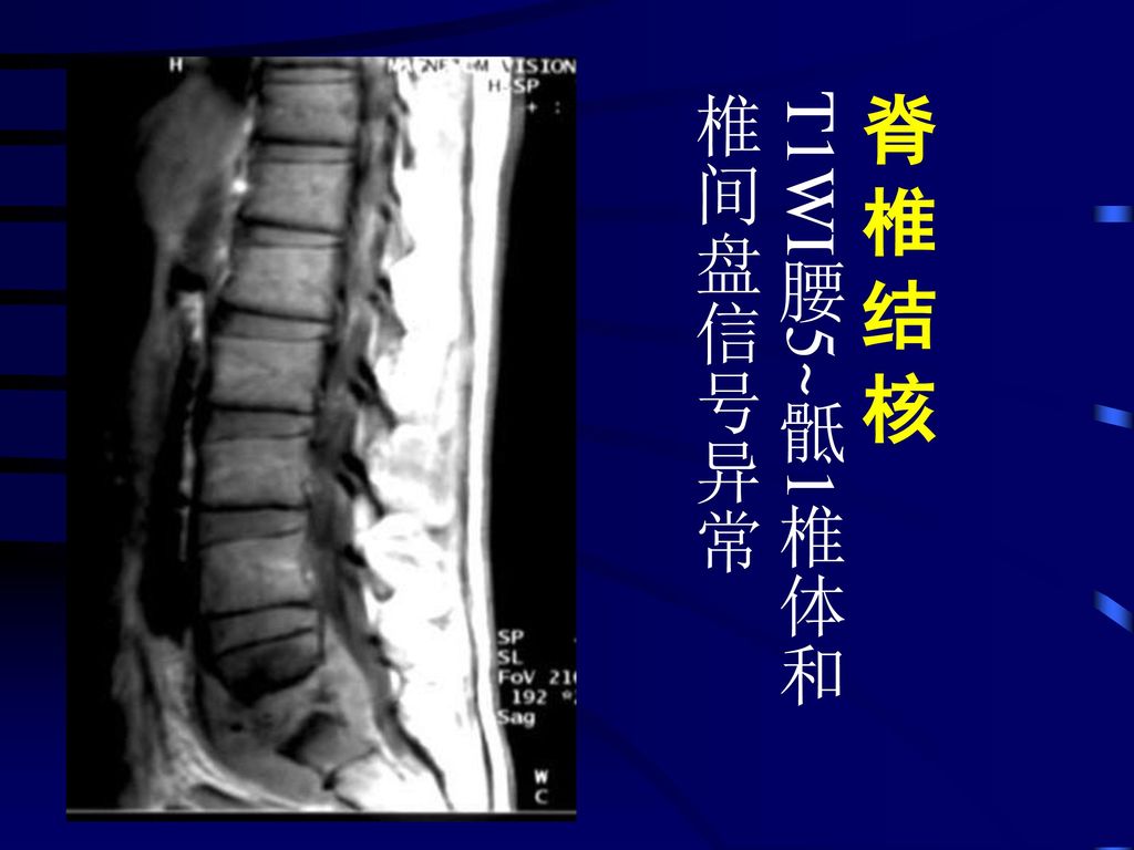 脊 椎 结 核 T1WI腰5~骶1椎体和椎间盘信号异常