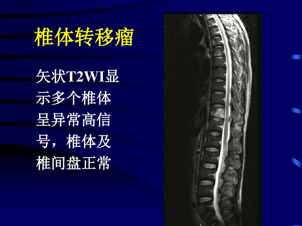 椎体转移瘤 矢状T2WI显 示多个椎体 呈异常高信 号，椎体及 椎间盘正常