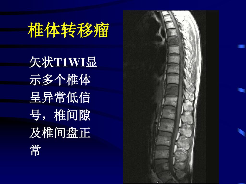 椎体转移瘤 矢状T1WI显 示多个椎体 呈异常低信 号，椎间隙 及椎间盘正 常