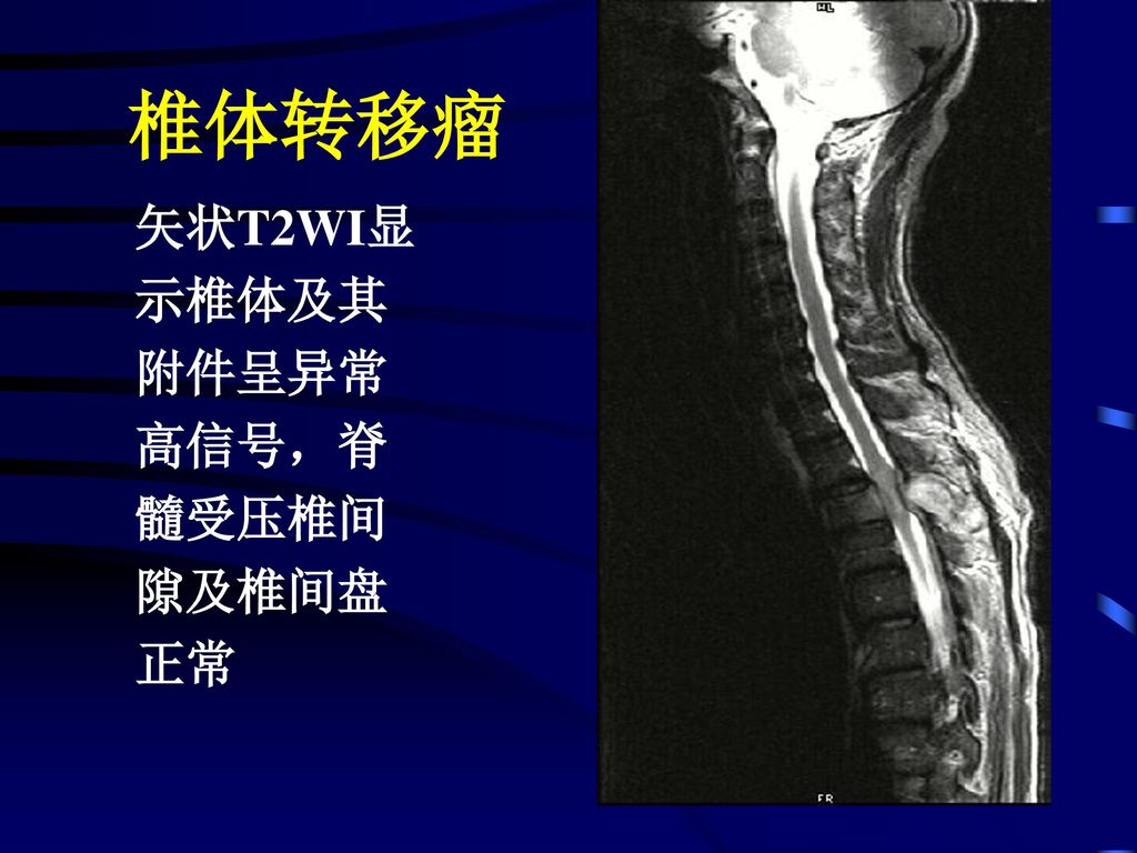 椎体转移瘤 矢状T2WI显 示椎体及其 附件呈异常 高信号，脊 髓受压椎间 隙及椎间盘 正常