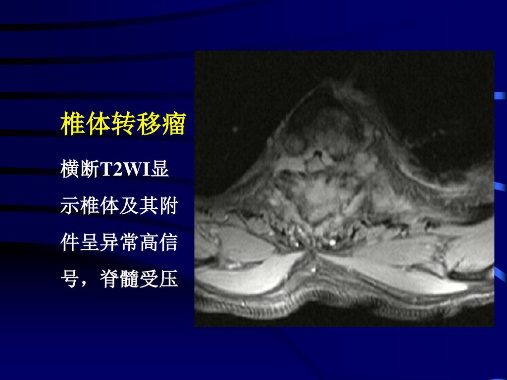 椎体转移瘤 横断T2WI显 示椎体及其附件呈异常高信号，脊髓受压