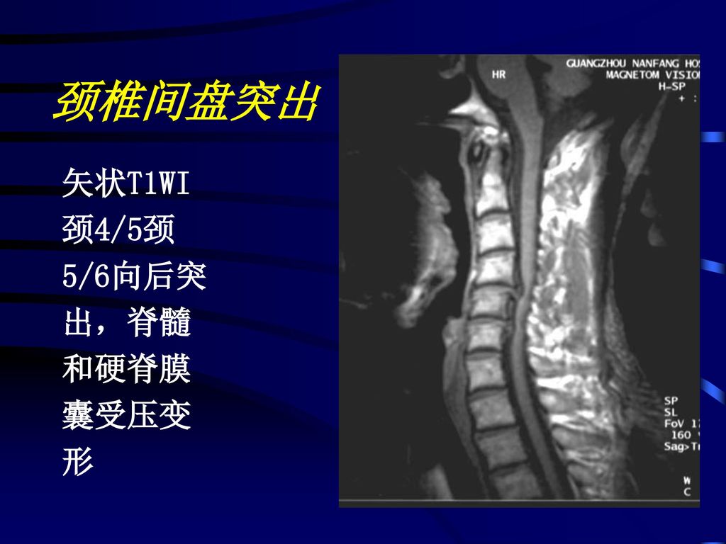 颈椎间盘突出 矢状T1WI 颈4/5颈 5/6向后突 出，脊髓 和硬脊膜 囊受压变 形
