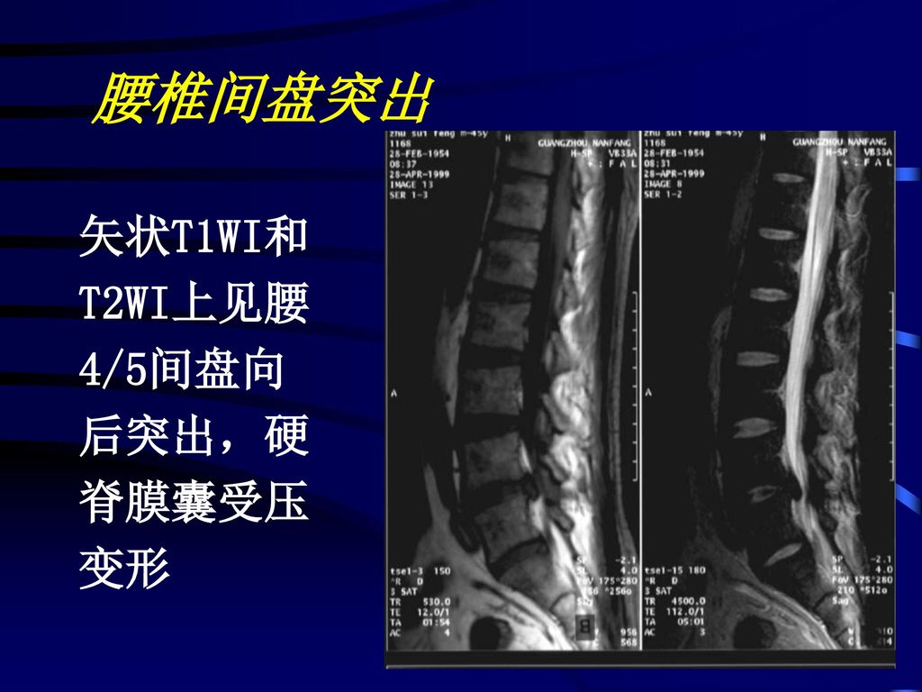 腰椎间盘突出 矢状T1WI和 T2WI上见腰 4/5间盘向 后突出，硬 脊膜囊受压 变形