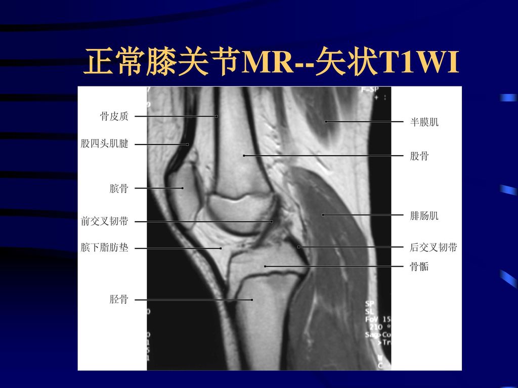 正常膝关节MR--矢状T1WI