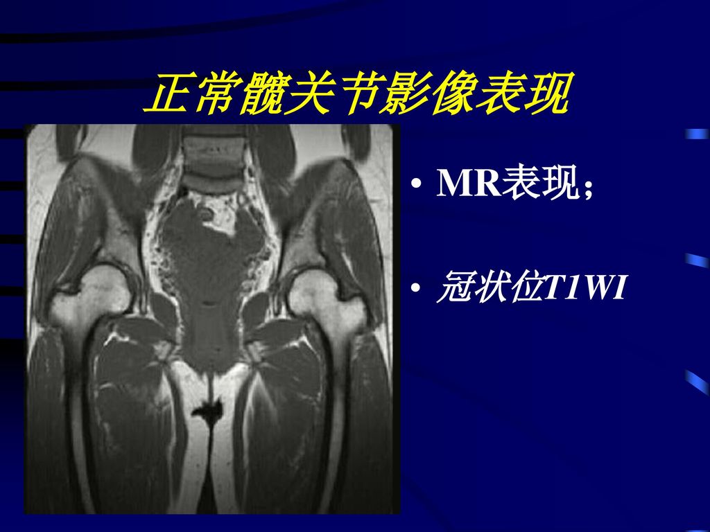 正常髋关节影像表现 MR表现； 冠状位T1WI
