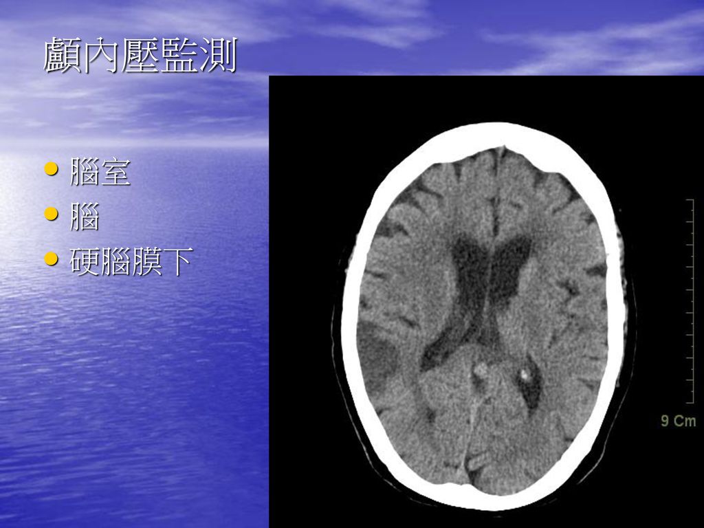 顱內壓監測 腦室 腦 硬腦膜下