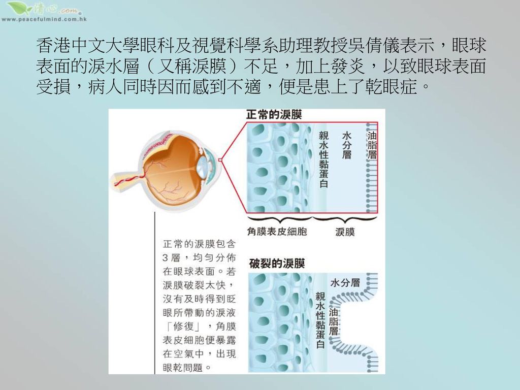香港中文大學眼科及視覺科學系助理教授吳倩儀表示，眼球表面的淚水層（又稱淚膜）不足，加上發炎，以致眼球表面受損，病人同時因而感到不適，便是患上了乾眼症。