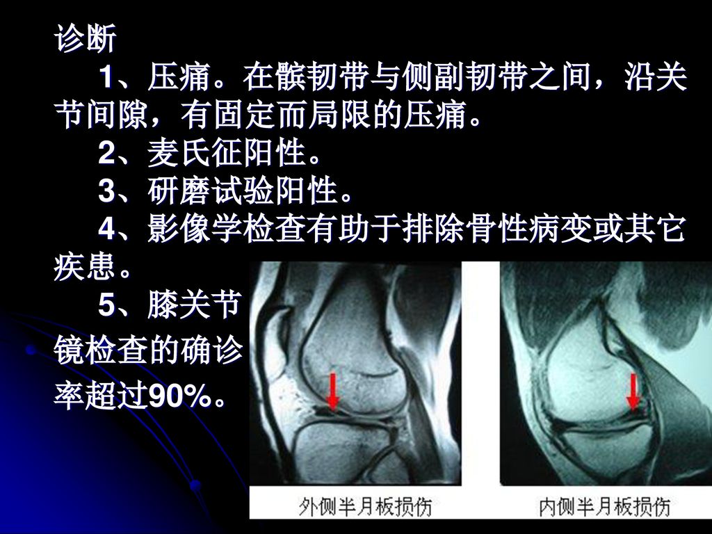 诊断. 1、压痛。在髌韧带与侧副韧带之间，沿关节间隙，有固定而局限的压痛。. 2、麦氏征阳性。. 3、研磨试验阳性。
