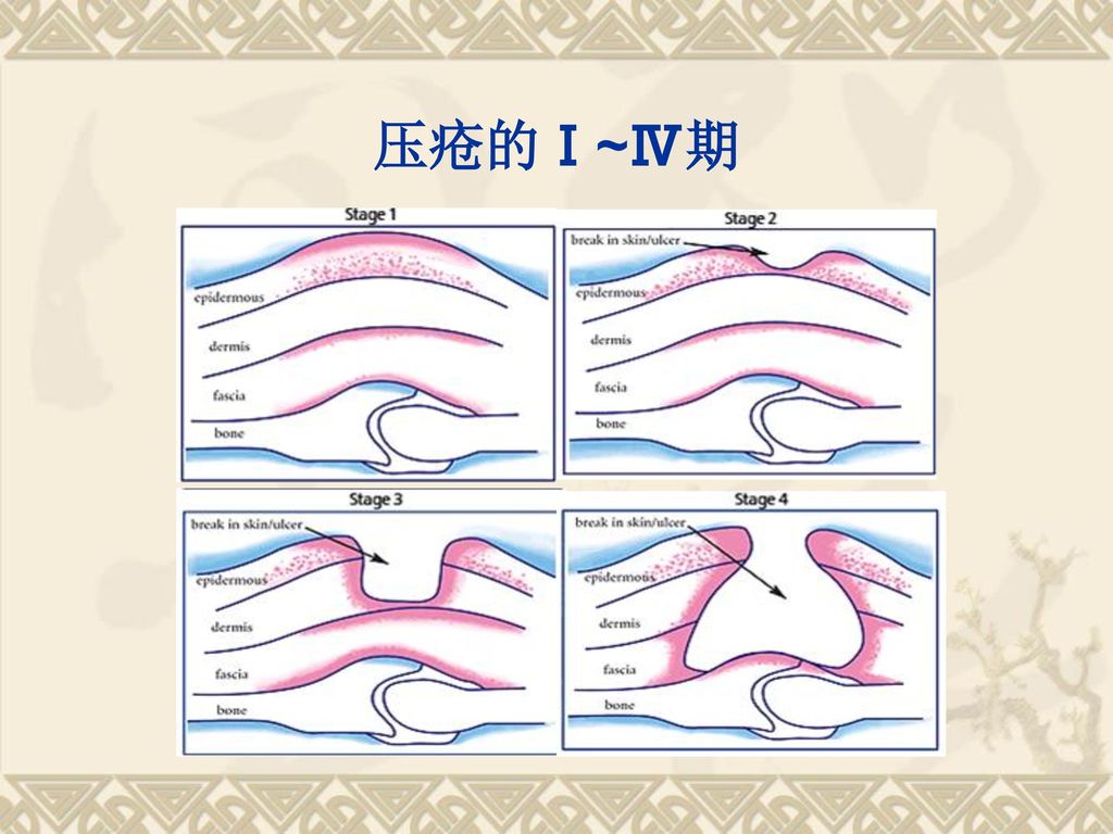 5 压疮的分期npuap1998压疮分期