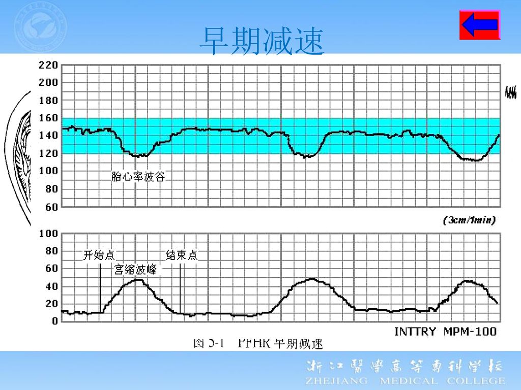 分为加速(增加15~20次/分)和减速(早期减速,减幅 50次/分;变异减速