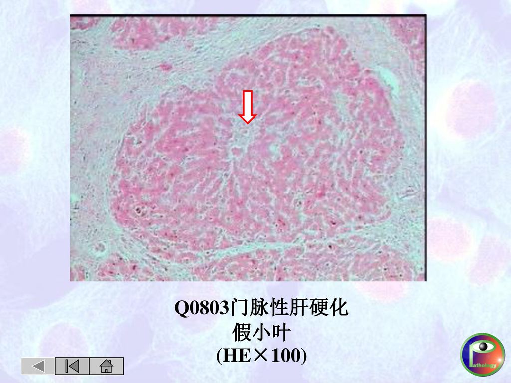 Q0803门脉性肝硬化 假小叶 (HE×100)