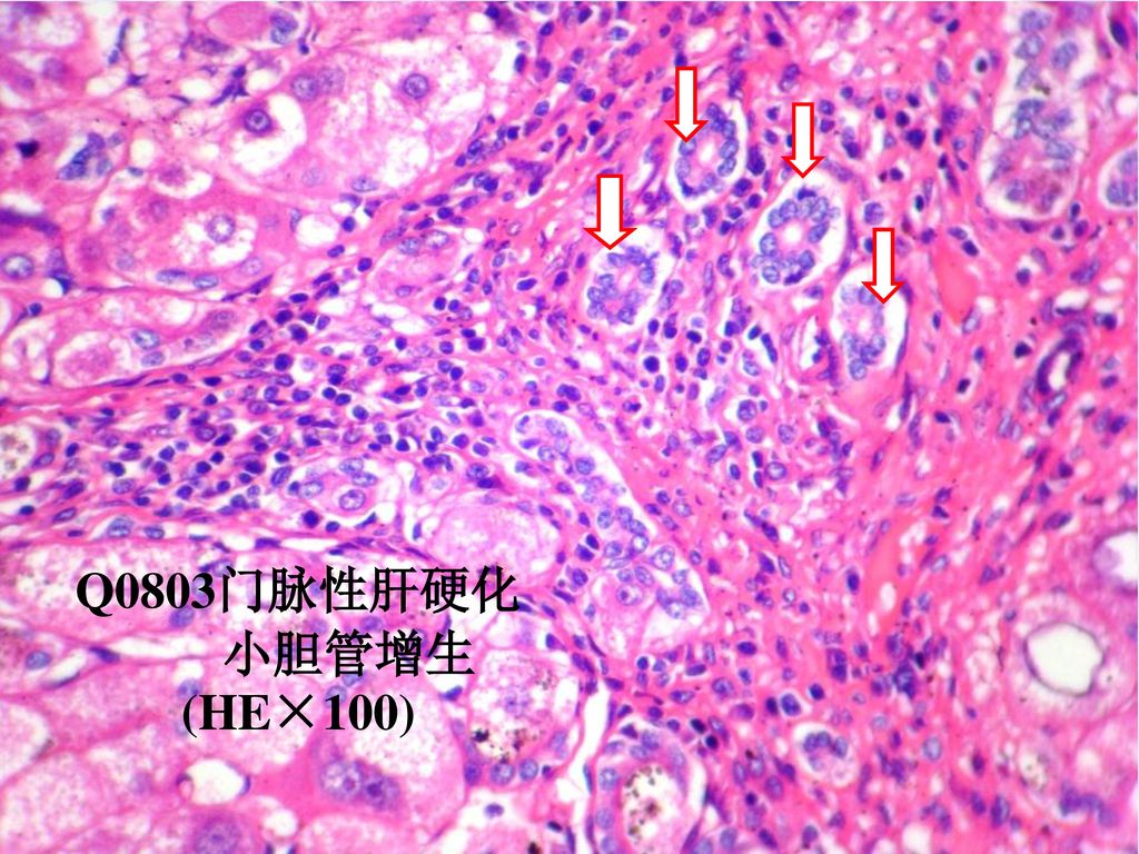 Q0803门脉性肝硬化 小胆管增生 (HE×100)