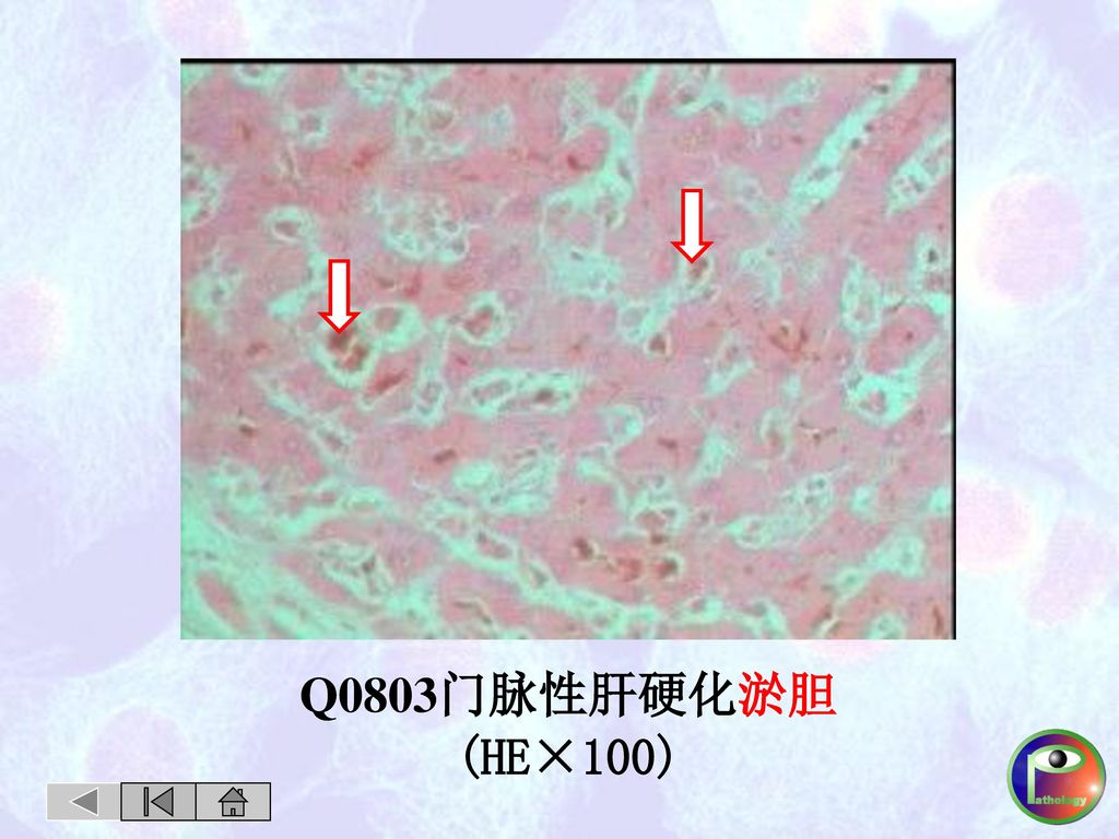 Q0803门脉性肝硬化淤胆 (HE×100)