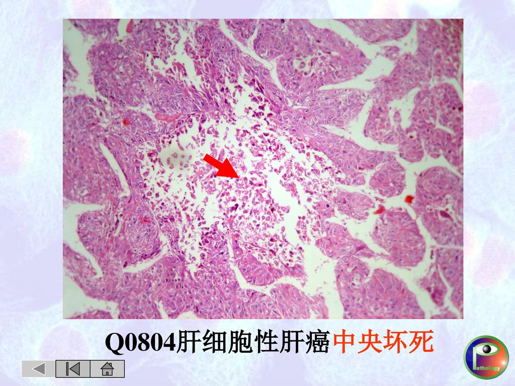 Q0804肝细胞性肝癌中央坏死