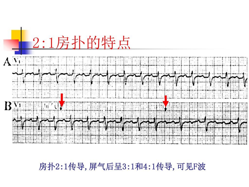 2:1房扑的特点 ——bix法则 Ⅰ型房扑的f波频率多数为250-300bpm 房室