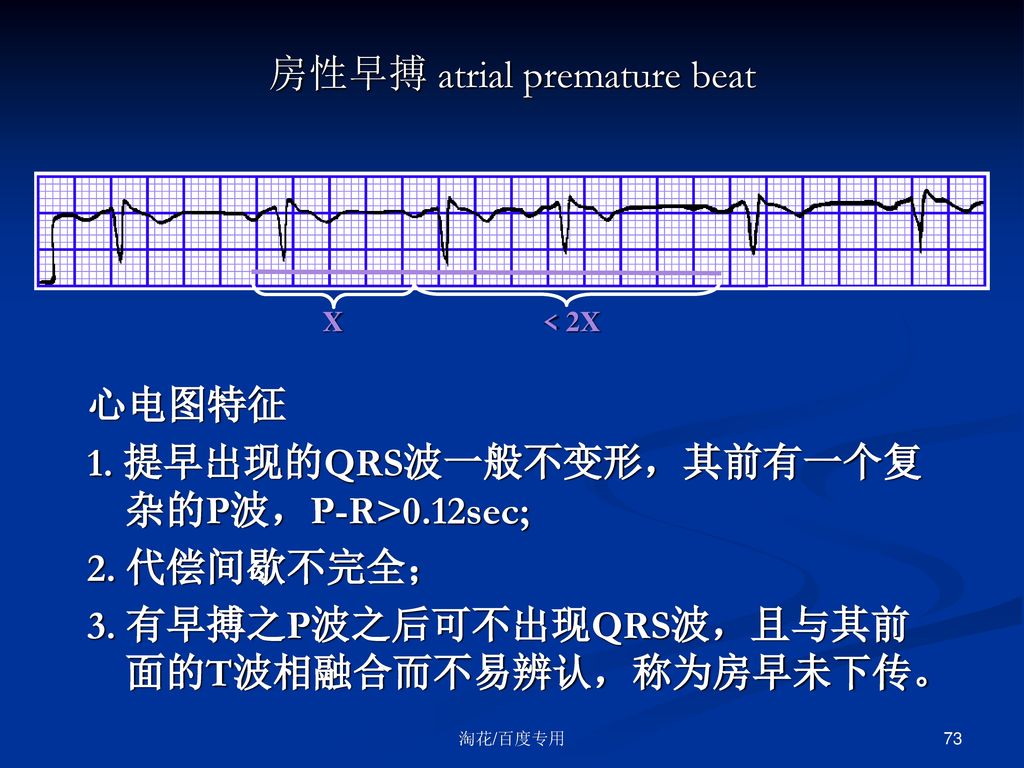 房性早搏 atrial premature beat x   2x心电图特征1.